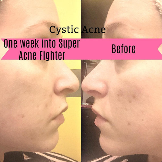 Super Acne fighter, Best Acne Fighting